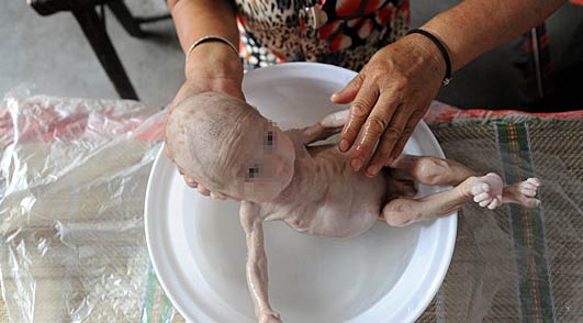男婴出生无肝门 肌肉萎缩骨瘦如柴似“外星人 郭恩泽的身体由于营养不良，开始萎缩。”