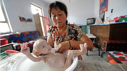 男婴出生无肝门 肌肉萎缩骨瘦如柴似“外星人” 郭恩泽的大姑在为他洗澡