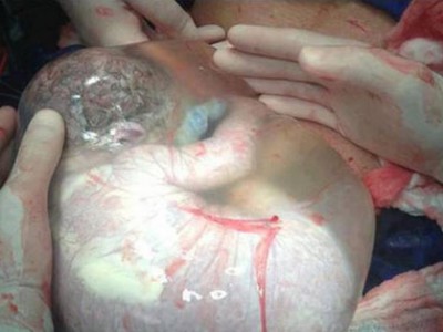 惊奇！婴儿产下后羊膜囊居然完整