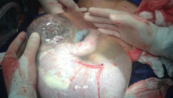 惊奇！婴儿产下后羊膜囊居然完整