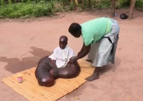 非洲男孩得怪病 腿长1.5米打破医学记录